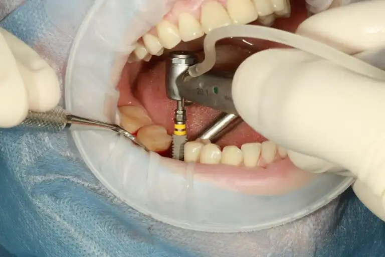 Zubní implantáty Turecko